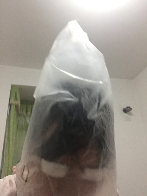 定點雙眼皮恢復過程圖_定點雙眼皮要多久恢復