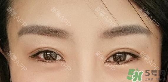 埋線雙眼皮能保持多久？埋線雙眼皮是永久嗎