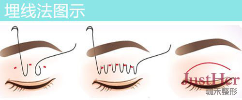 定點(diǎn)雙眼皮怎么做？定點(diǎn)雙眼皮需要拆線嗎？