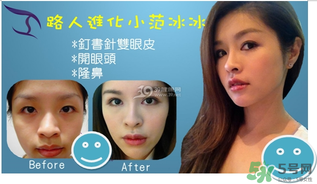 重瞼術是什么？重瞼術是永久的嗎？