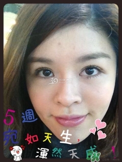 重瞼術是什么？重瞼術是永久的嗎？