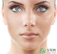 點陣激光后多久恢復正常膚色?點陣激光要多久恢復?