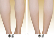 小腿吸脂多久見效？小腿吸脂后多久能看見效果？