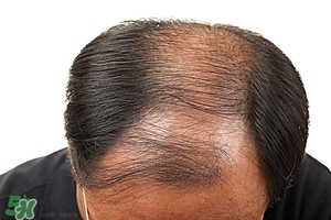 溢脂性脫發怎么治療?溢脂性脫發是什么原因