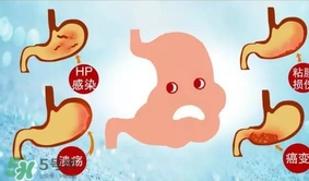 神經性胃痙攣是什么？神經性胃痙攣是什么原因？