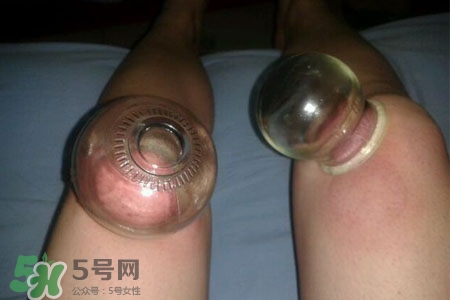小腿能拔罐嗎？在小腿上拔火罐有什么作用？