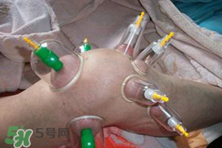 小腿能拔罐嗎？在小腿上拔火罐有什么作用？