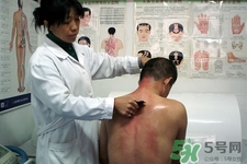 刮痧可以去濕氣嗎？體內濕氣重刮痧有用嗎？