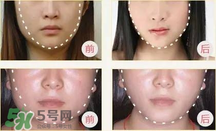 打完瘦臉針多久可以化妝？打完瘦臉針的反應
