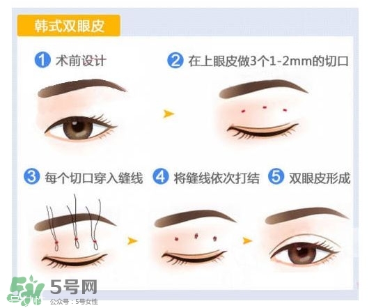 割雙眼皮有幾種做法？雙眼皮有哪幾種形狀？