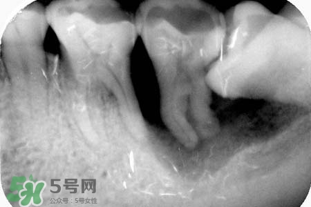 智齒會引起耳鳴嗎？耳鳴跟智齒有關(guān)系嗎？
