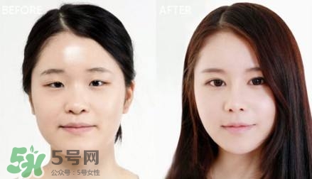 割雙眼皮有什么后遺癥嗎？割雙眼皮有什么危害性？
