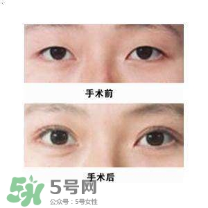割雙眼皮疼不疼？割雙眼皮疼幾天能好？