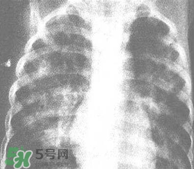 紅眼病是怎么引起的？紅眼病怎么產生的