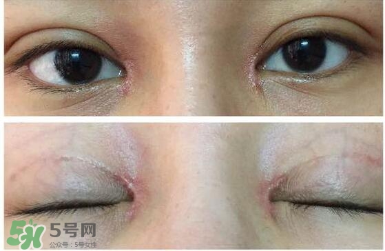 眼角增生是什么意思？眼角增生了怎么辦？