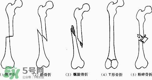 骨折吃什么好得快？骨折后注意事項