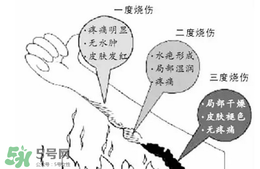 燙傷起泡要挑破嗎？燙傷起泡怎么處理？