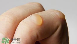 燙傷起泡要挑破嗎？燙傷起泡怎么處理？