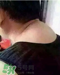 刮痧之后可以艾灸嗎？刮痧之后可不可以艾灸