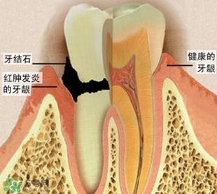 牙結石是什么？牙結石圖片