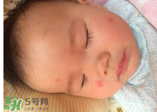 嬰兒蚊子咬了怎么消腫？嬰兒蚊子咬了怎么消腫止癢最快？