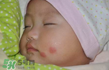 嬰兒被蚊子咬了如何去紅點？被蚊子咬后紅點如何去除？