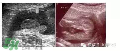 B超單數(shù)據(jù)怎么看男女？B超單看男女準(zhǔn)嗎？