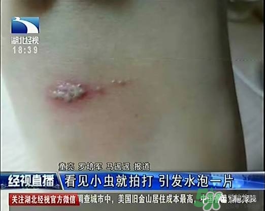 隱翅蟲有毒嗎？隱翅蟲會毀容嗎？