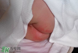 尿布疹怎么辦？寶寶尿布疹擦什么藥好？