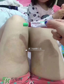 日本msd祛疤膏怎么樣？日本msd祛疤膏有用嗎？