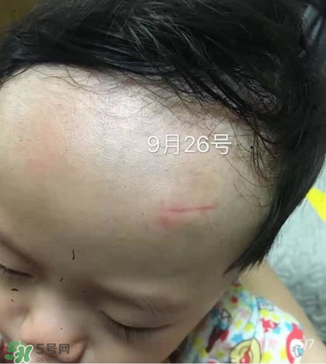 日本msd祛疤膏是抗生素嗎？日本msd祛疤膏是不是抗生素？