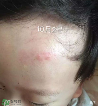 日本msd祛疤膏是抗生素嗎？日本msd祛疤膏是不是抗生素？