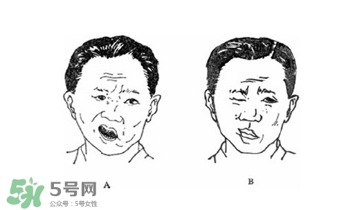 面癱是什么導致的？面癱多久徹底恢復正常