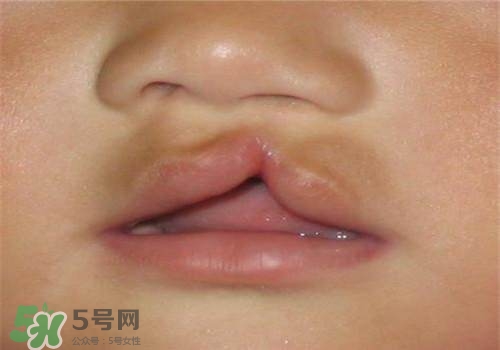兔唇能檢查出來嗎？兔唇能完全修復嗎？