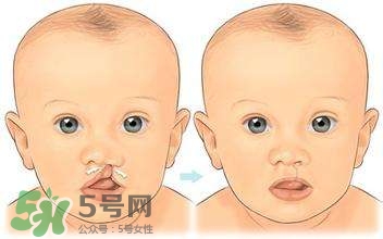 兔唇能檢查出來嗎？兔唇能完全修復嗎？