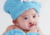 兔唇可以治嗎？兔唇修補術