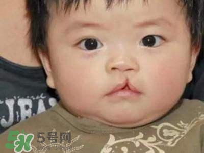 兔唇可以治嗎？兔唇修補術