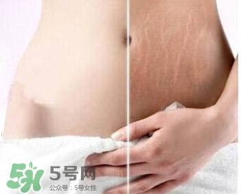 妊娠紋怎么長在大腿上了？妊娠紋會不會長在大腿上？