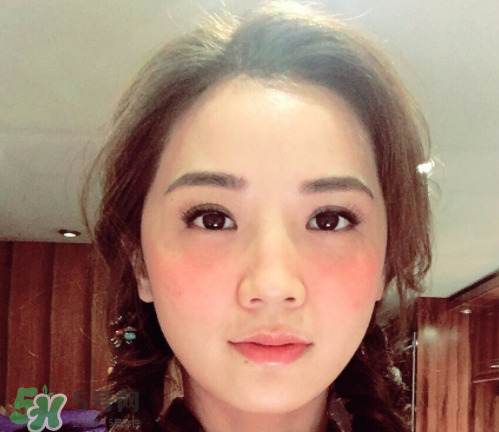 夏天可以點痣嗎？夏天點痣后要注意什么？