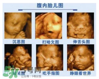 四維彩超有必要做嗎？四維彩超檢查不出什么？