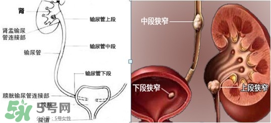 腎結石怎么治最好？腎結石的醫治方法