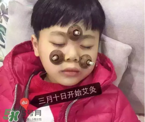 艾灸貼可以治咳嗽嗎？艾灸貼可以治退燒嗎？
