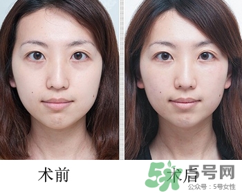 填充淚溝有風險嗎？填充淚溝的方法