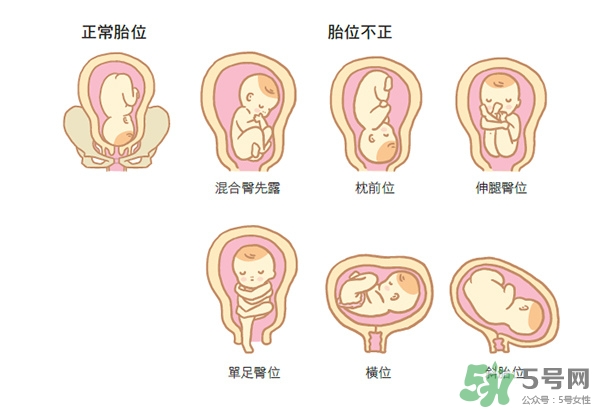 胎位不正如何矯正？胎位不正一定要剖腹產嗎？