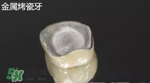 烤瓷牙和全瓷牙有什么區別?烤瓷牙和全瓷牙的區別