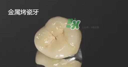 烤瓷牙和全瓷牙有什么區別?烤瓷牙和全瓷牙的區別