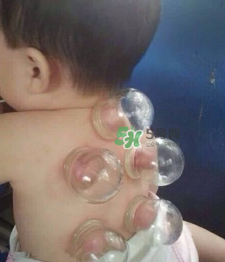 拔火罐后顏色多久消失？拔火罐印子多久能消除？