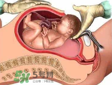 剖腹產比順產安全嗎？剖腹產產后注意事項？