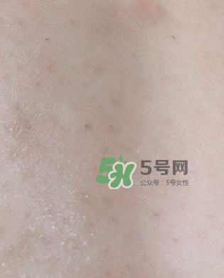 Dermatix舒痕疤痕膏有效嗎？Dermatix舒痕疤痕膏怎么用？
