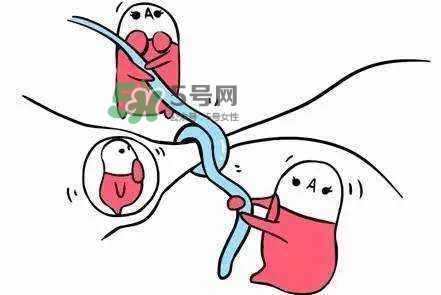 結扎好還是上環好？結扎上環哪個危害小？